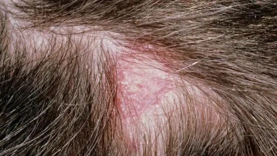 春天到,头皮痒?试试"中西医"治疗方