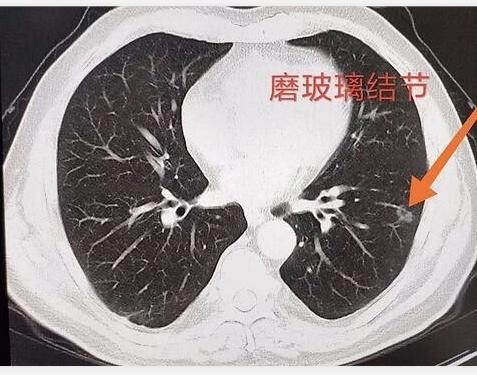 新冠肺炎肺部图片