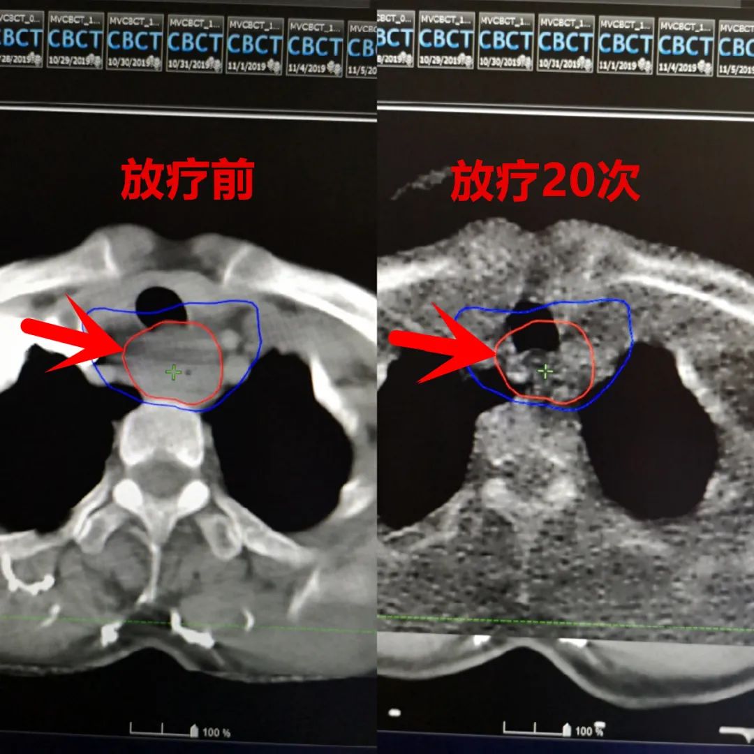 肿瘤患者5次放疗后安稳睡觉一个周期后体重增长了20斤看这款放疗神器