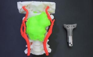 脖子也能靠打印置換了？3D打印技術助醫生闖過手術禁區
