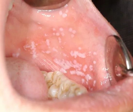 白色念珠菌感染 口腔图片
