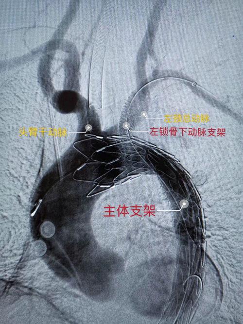 主动脉夹层 苏州科技城医院介入血管外科又完成一高难度手术