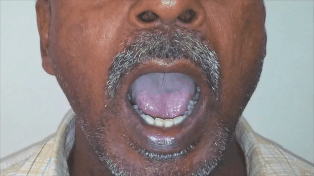 特别注意:舌震颤可能是脑梗死的独立症状