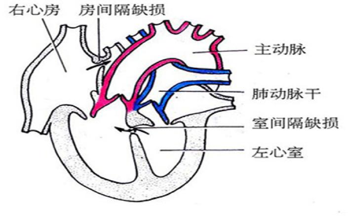 疫情期间如何应对儿童房间隔缺损