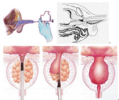 早期前列腺癌患者应首选手术治疗.