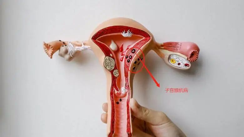 子宫腺肌病,是指子宫内膜腺体和基质侵入子宫肌层形成局灶性或弥漫性