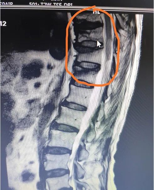 Medex. Post-op stabilization trauma , compression fracture,  spondyloisthesis , 術後固定, 腰椎骨折, 腰椎移位, 錯位, 腰痛, 坐骨神經痛