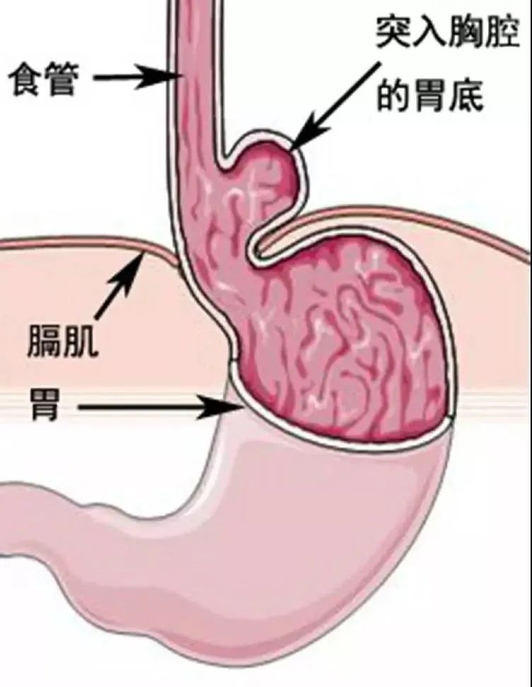 食管生理狭窄图片