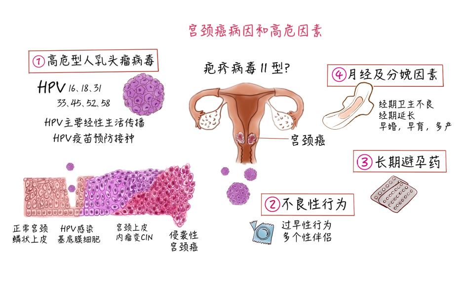 宫颈癌的早期症状图片