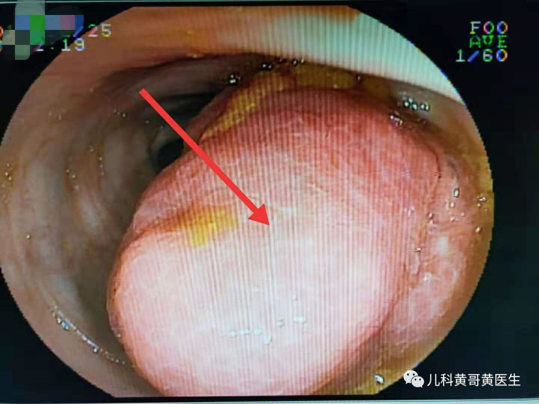 大便带血粉色图片