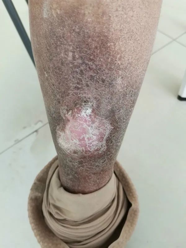 谢谢你们我这十多年的老烂腿可算是好了