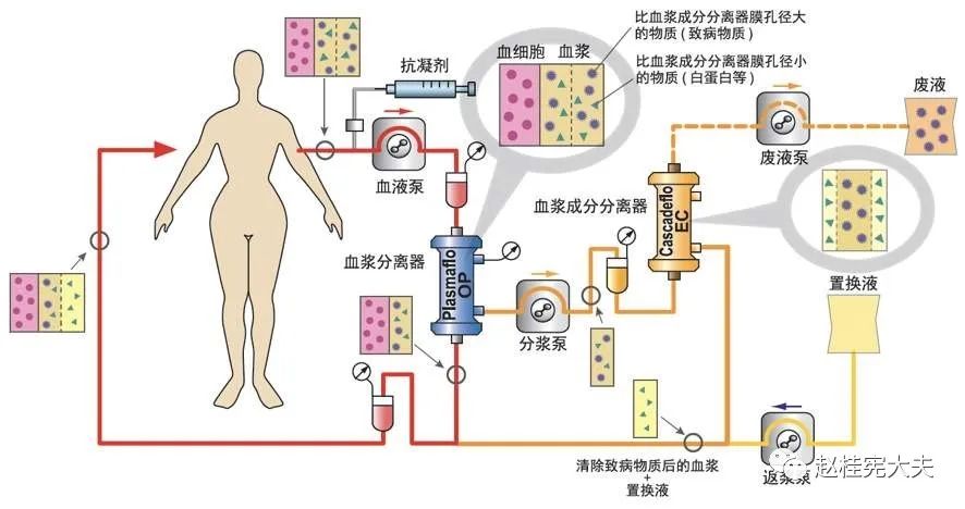 世界脑膜炎日 战胜脑膜炎的三驾马车之一 血浆置换 免疫吸附治疗 湃客 澎湃新闻 The Paper