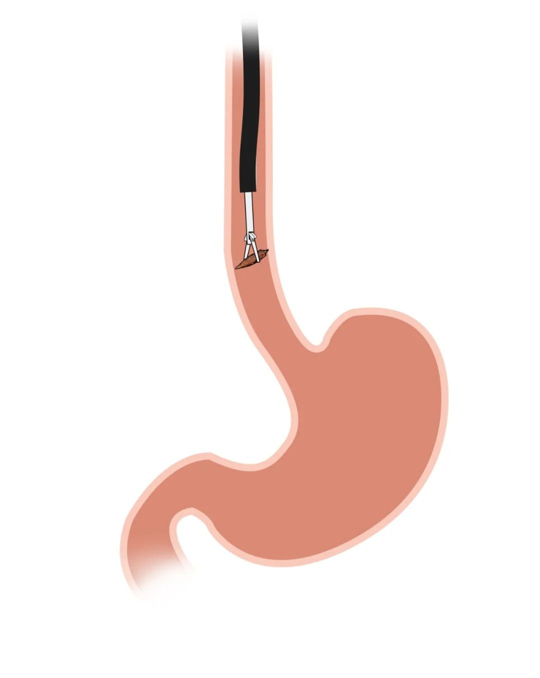 警惕"祸从口入",不小心吞入食管异物该怎么办?