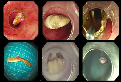 警惕祸从口入不小心吞入食管异物该怎么办