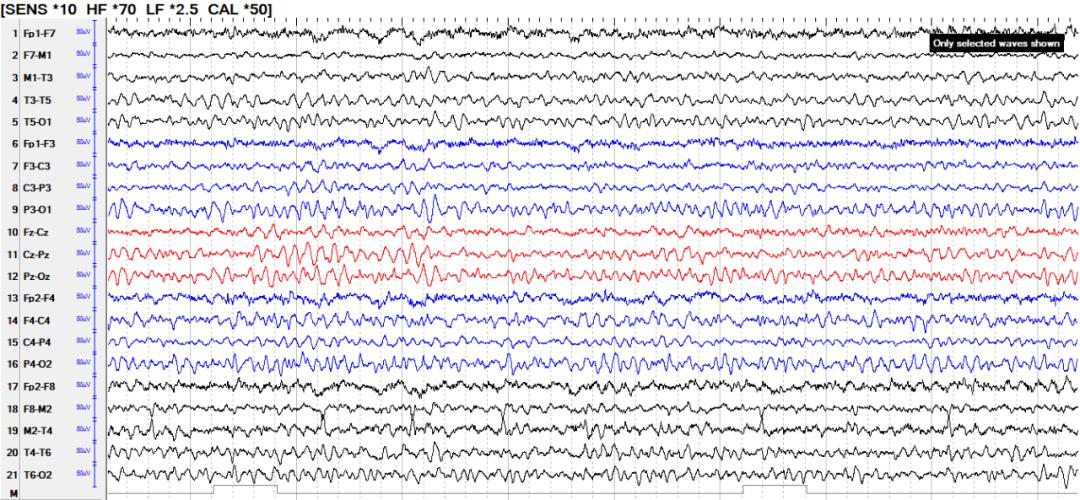 龚德山教授团队中央区难治性癫痫病例分享