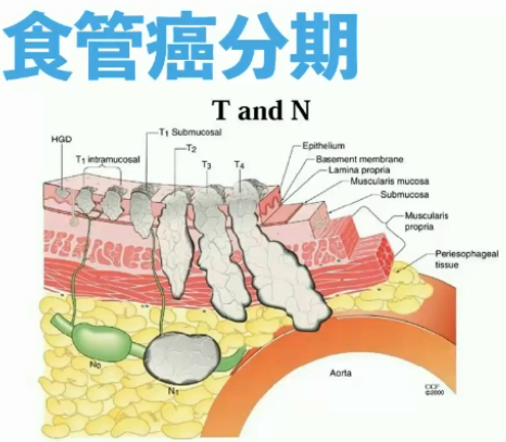 肿瘤防治宣传周李志刚全球一半食管癌都在中国真的是因为吃错了吗