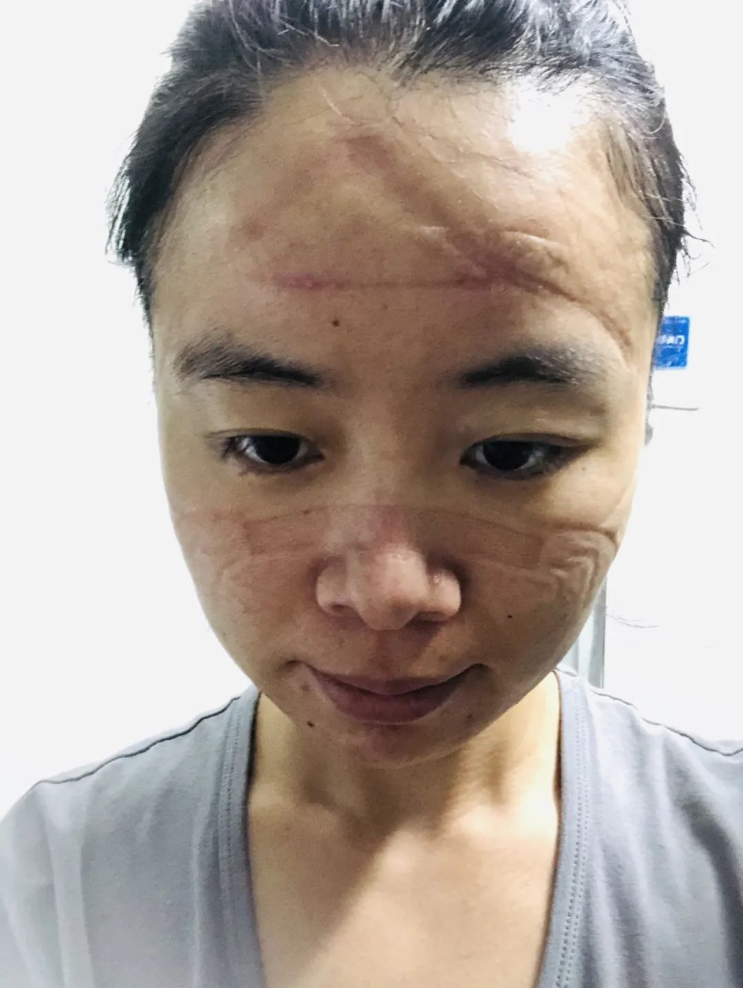 战“疫”日记：印满勒痕的脸是最美的-国内频道-内蒙古新闻网