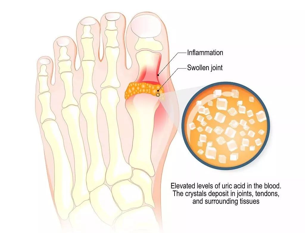 痛风的脚趾大拇指关节处及其中沉积的尿酸盐晶体(圆圈内特写).