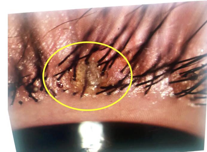 该院门诊副护士长王亚灵在裂隙灯下夹起吸附在甜甜睑缘上的阴虱,虫卵