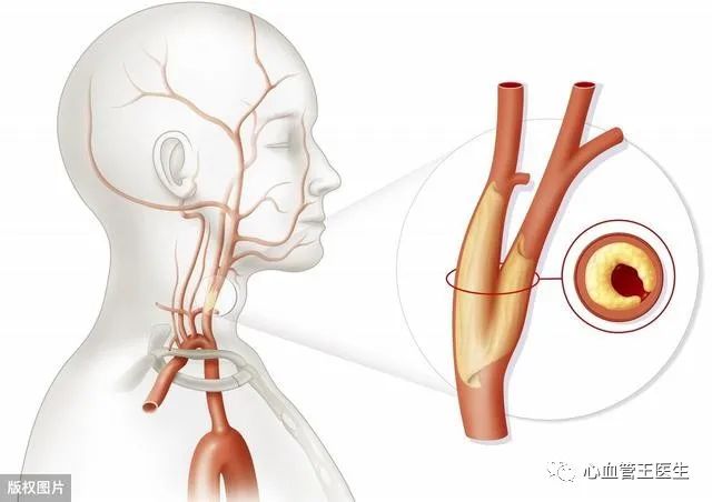 颈动脉结节位置图片图片