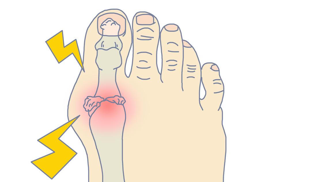 药也吃了也忌口了为何痛风还是反复发作