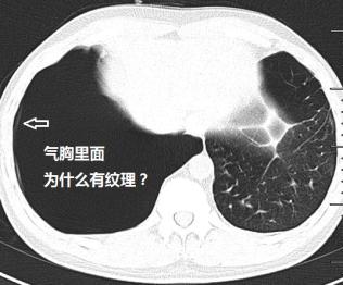包裹性气胸or肺大泡这里有3个精彩病例