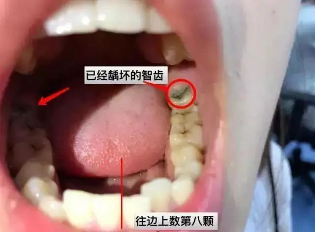 智齿该拔就拔难不成还要留着过年