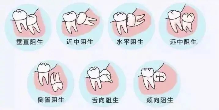大多数人是4颗,有的少于4颗,有的甚至一辈子都不出,长智齿的年龄也很
