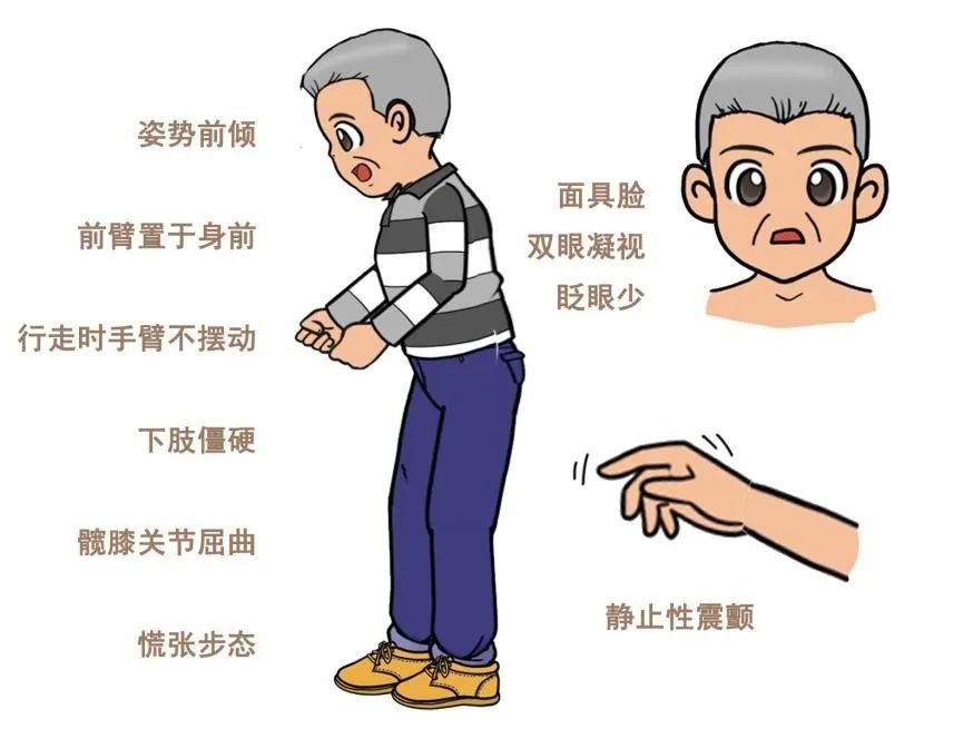 其主要表现可分为两大类:第一大类,运动症状,包括静止性震颤,运动迟缓