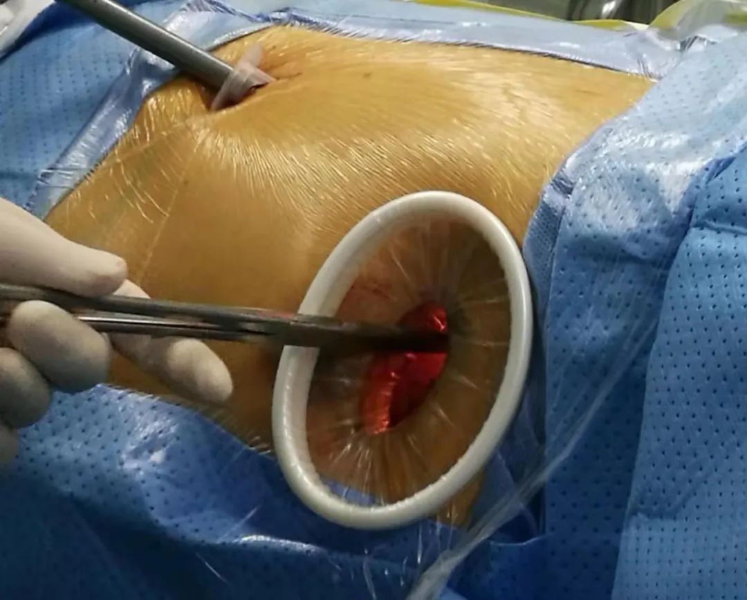 极致"精准"!我院胸外科成功开展多例"胸腔镜下肺段切除术"