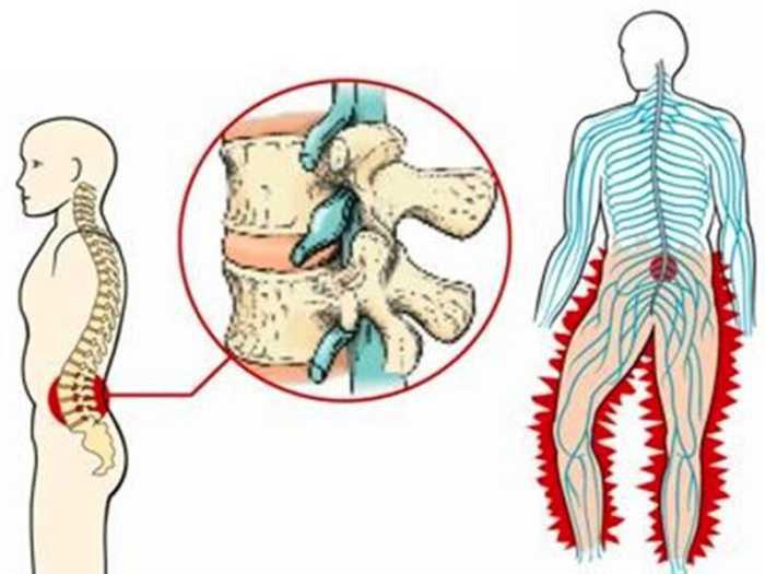 很多时候腰突症患者没有腰痛,倒是有臀部和腿疼