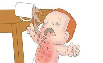 男婴被100℃洗澡水烫伤，妈妈的急救连医生都点赞