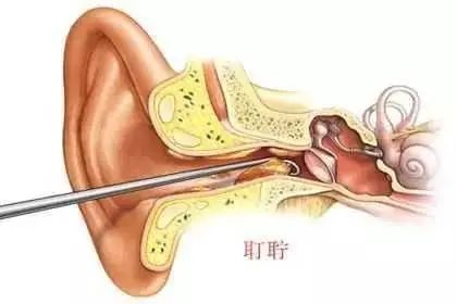耳屎到底要不要挖原来这么多年我们都做错了