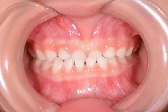 健康科普孩子牙齿矫正畸形的疑问答案都在这里啦