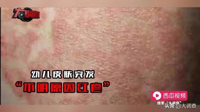 震惊假奶粉致使湖南又现大头娃娃