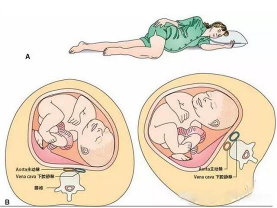 孕晚期子宫右旋图片图片