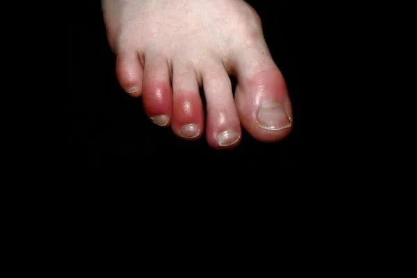 脚趾冻疮症状图片图片