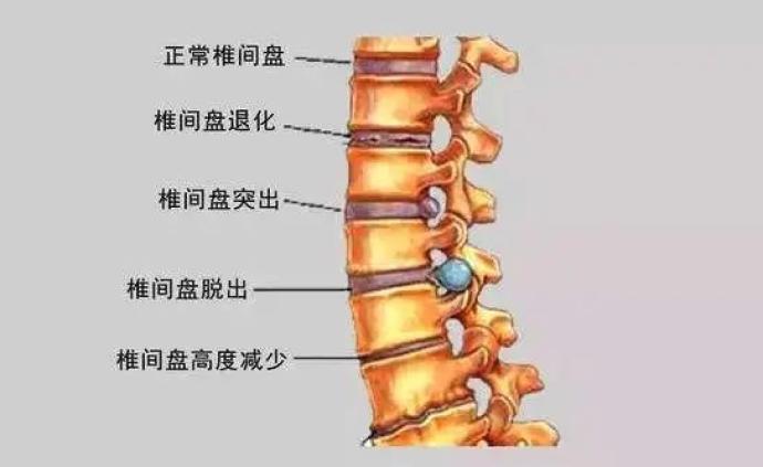 世界脊柱日 | 腰痛有哪几种主要来源