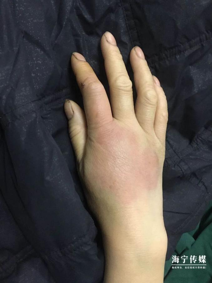 在记者采访期间,又来了一位被蜈蚣咬伤的陈阿姨,"我当时戴着手套在