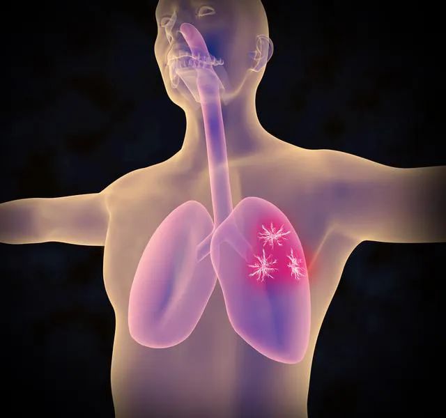 肺癌晚期发热原因不仅仅是感染肿瘤自身发热也是常见原因
