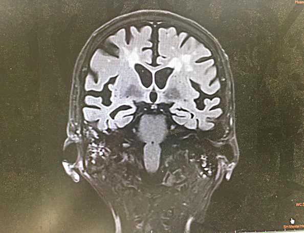 家裡人帶他去醫院做了頭顱mri,結果是右側顳葉,雙側放射冠區及額葉