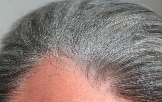 白头发是什么原因导致的遗传占了一部分疾病占了一部分