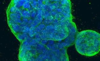 晚期乳腺癌患者中找到一种神秘蛋白，有望治疗乳腺癌