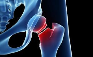 如何解救“人生最后一次骨折”？上海六院闵行骨科联盟启动