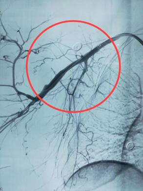 术前(左)vs术后(右),血管造影此时,距离伤口再次涌血已经过了近两个