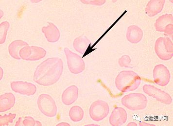 泪滴样红细胞外形不规则,有2至3个尖角呈盔形,多见于弥散性血管内凝血