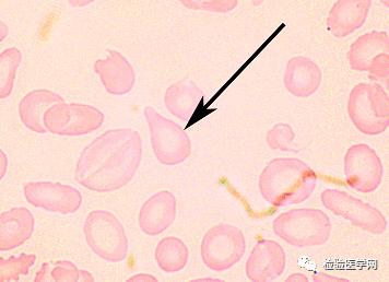 泪滴状红细胞图片