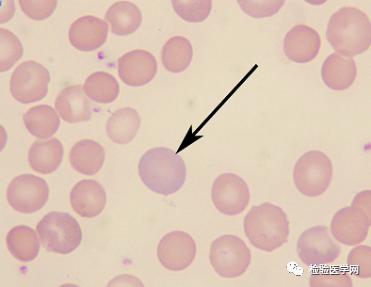 嗜碱性点彩红细胞红细胞内可见蓝色小颗粒,大小不等,散在分布,是一种