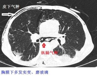 注意,抗mda5阳性皮肌炎相关间质性肺病不好治疗,并发纵隔气肿的时候