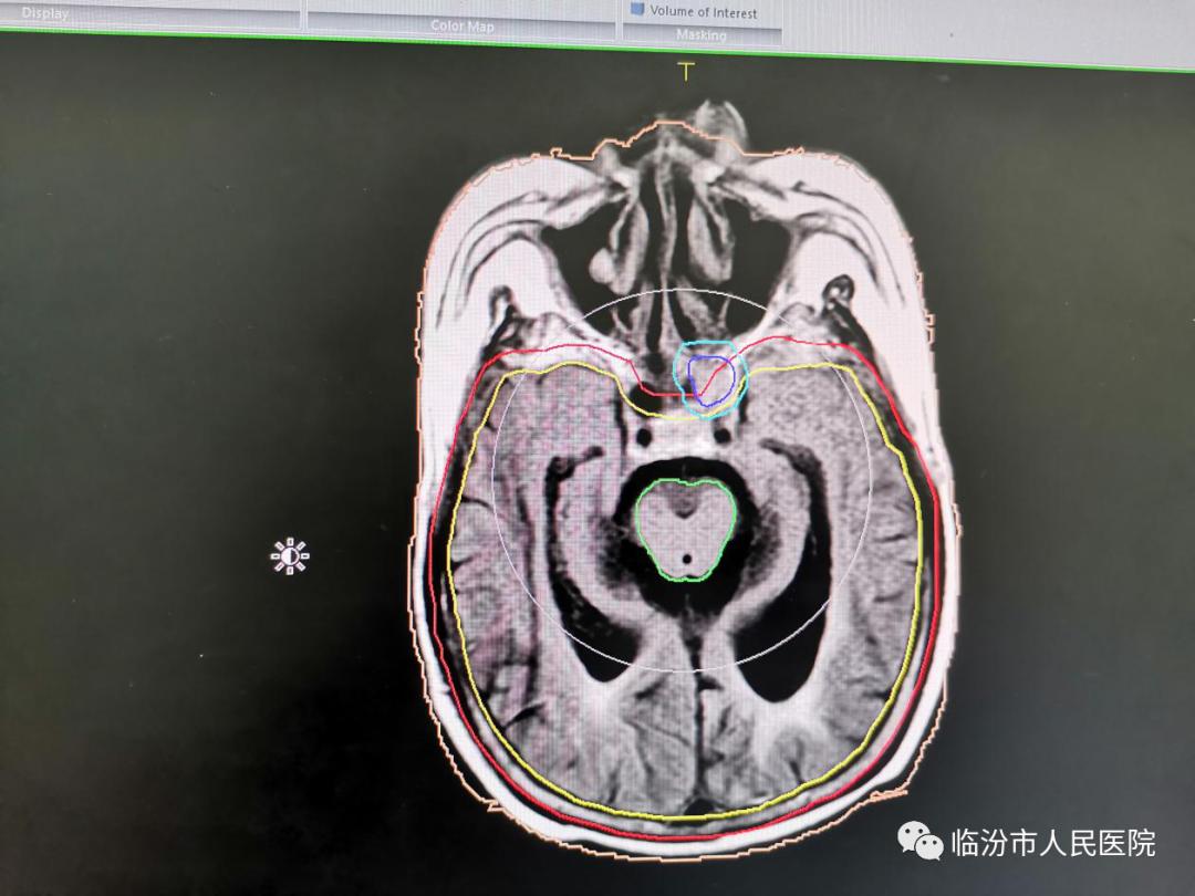 我院放射治疗中心新技术再上新台阶多模态医学影像融合技术技术新突破